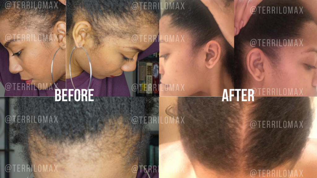 How a Hair Transplant Can Reverse Traction Alopecia and Thinning Edges