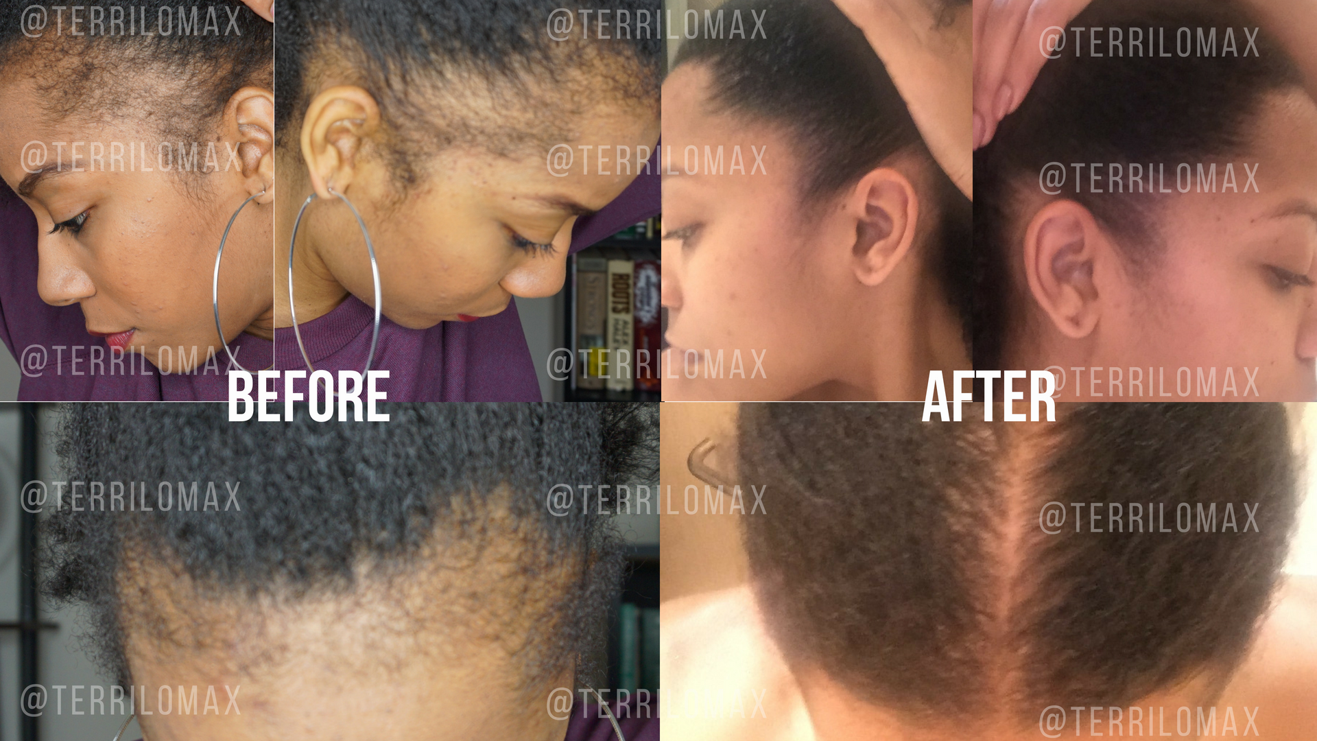 hairloss #alopecia #fyp #hairextensions #atlantahairstylist #onthisda, uv hair extensions